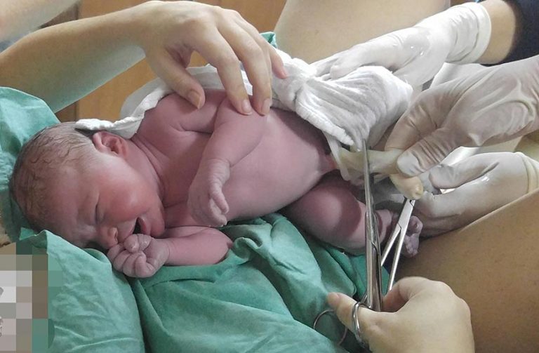 הרופאה חותכת את חבל הטבור לתינוק שנולד